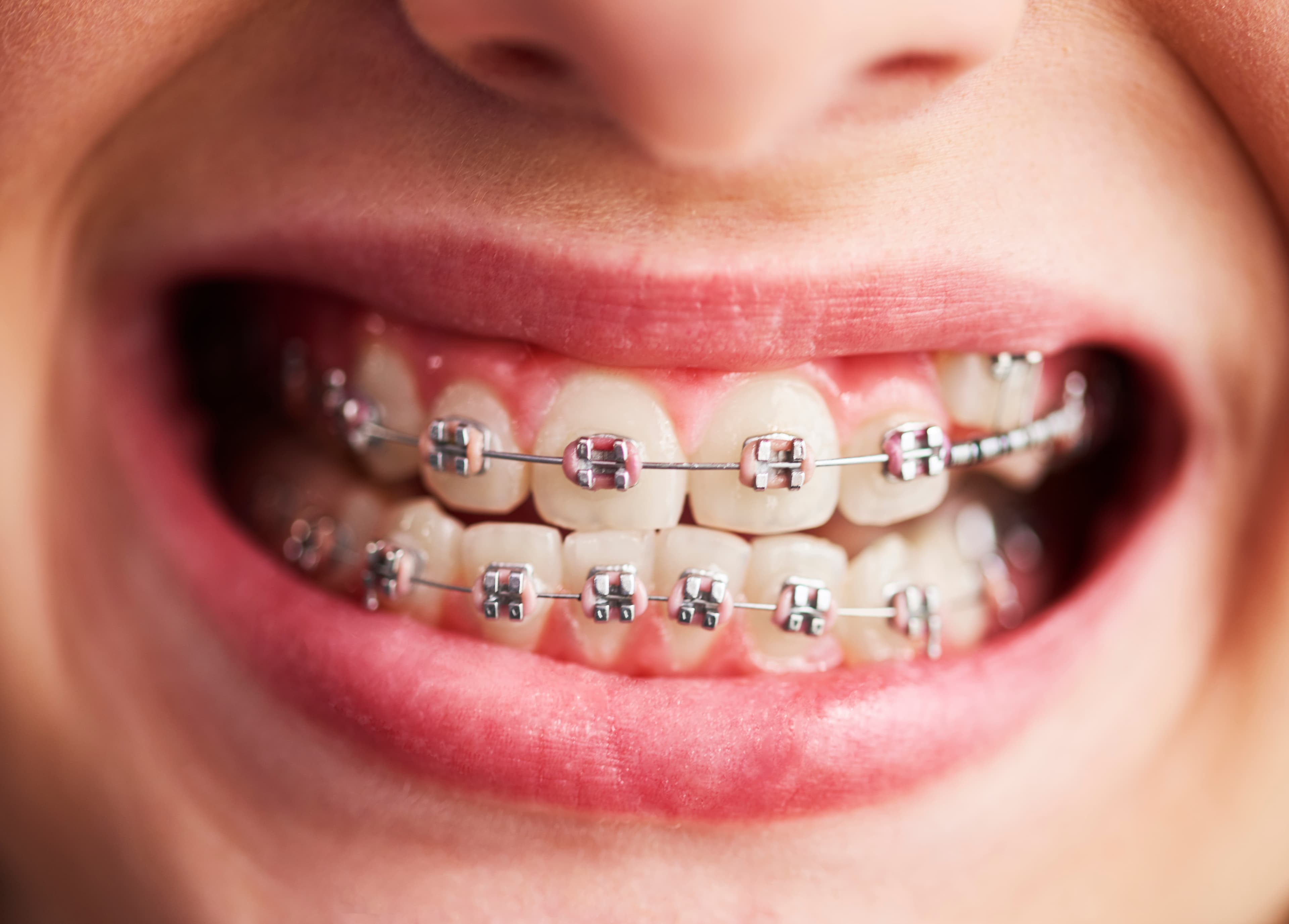 Orthodontics & Braces